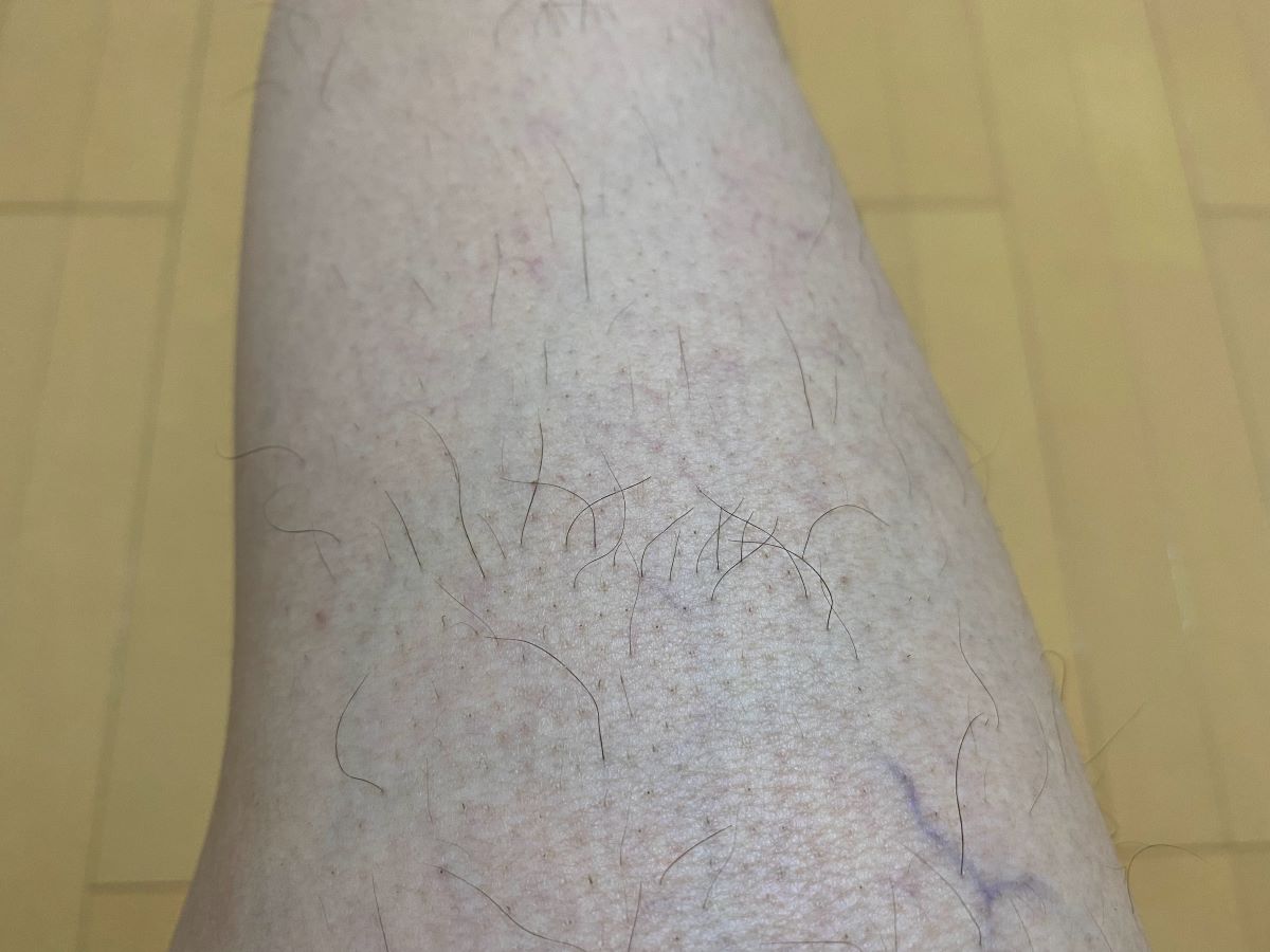 全身脱毛3回目の効果