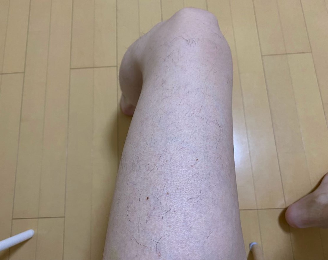 全身脱毛3回目の効果