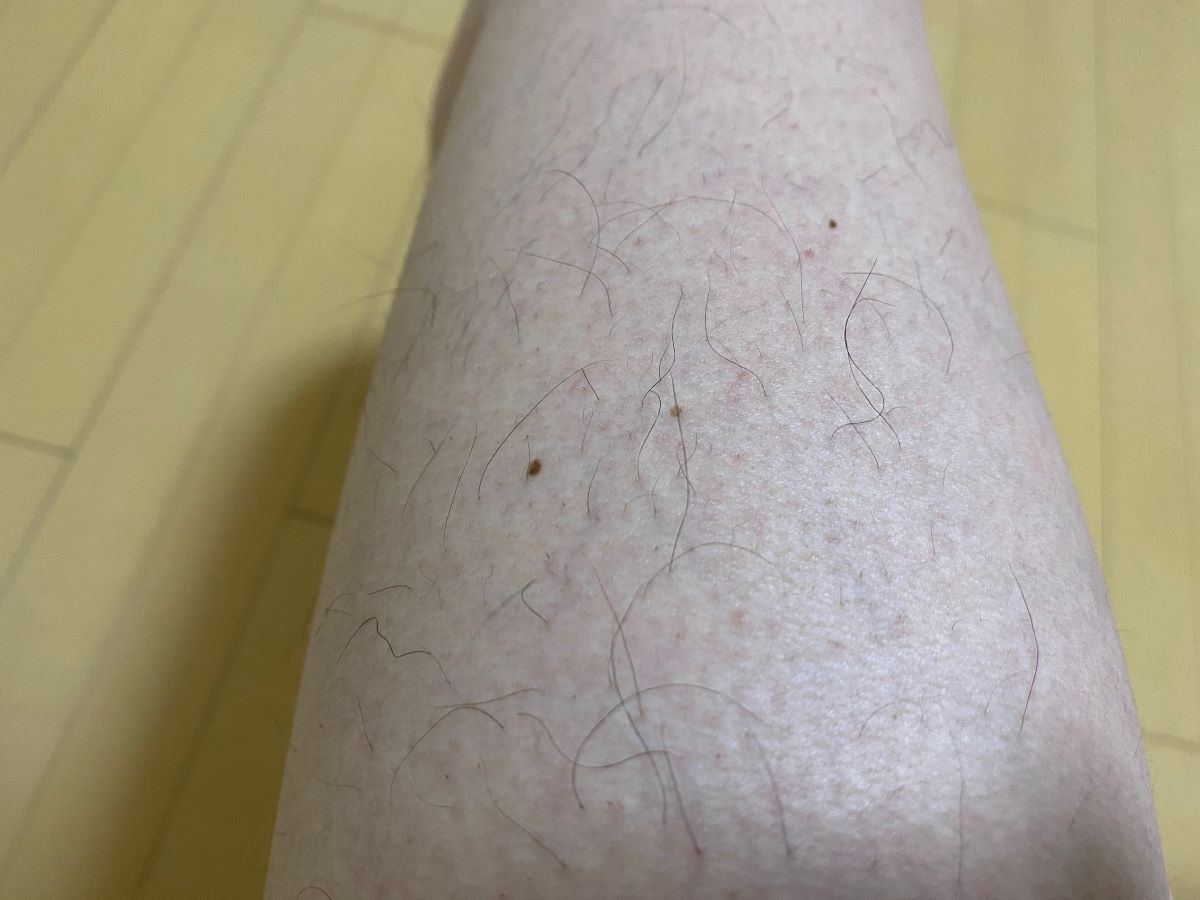 全身脱毛3回目の効果