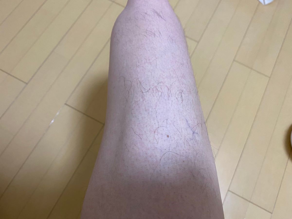 全身脱毛3回目の効果