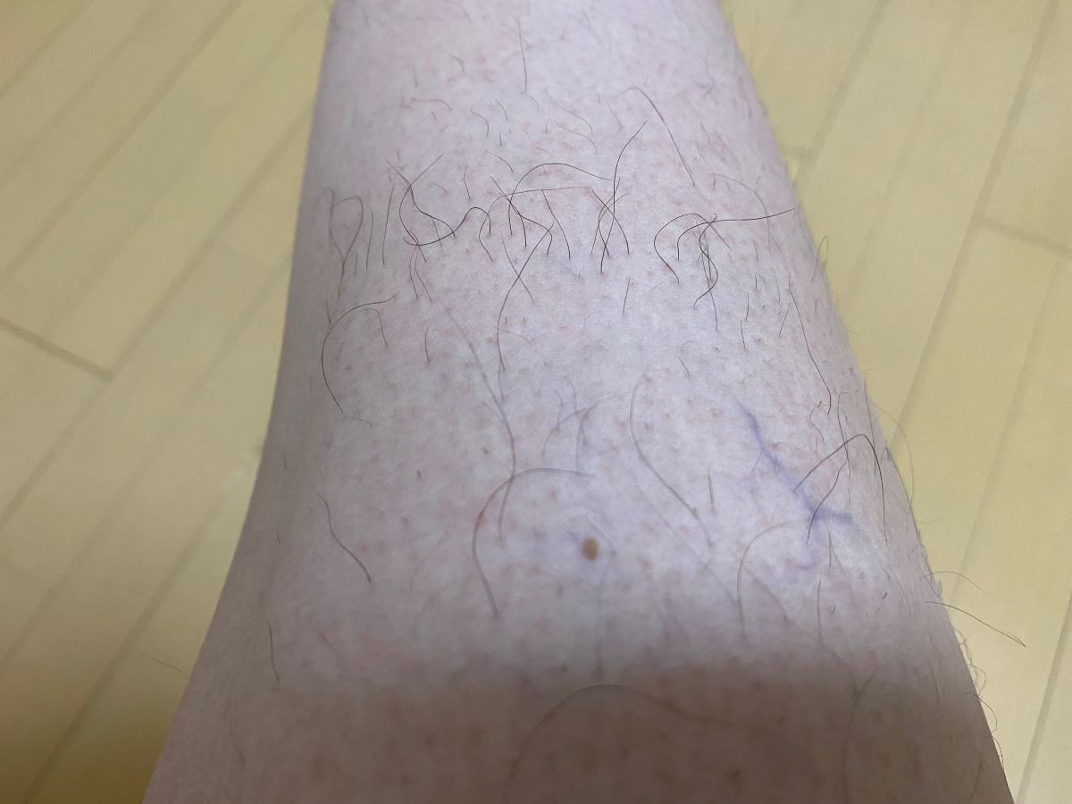 全身脱毛3回目の効果
