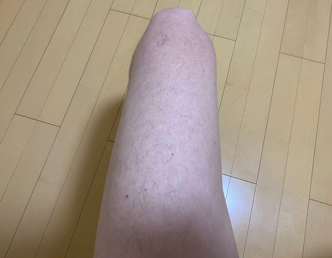 全身脱毛3回目の効果