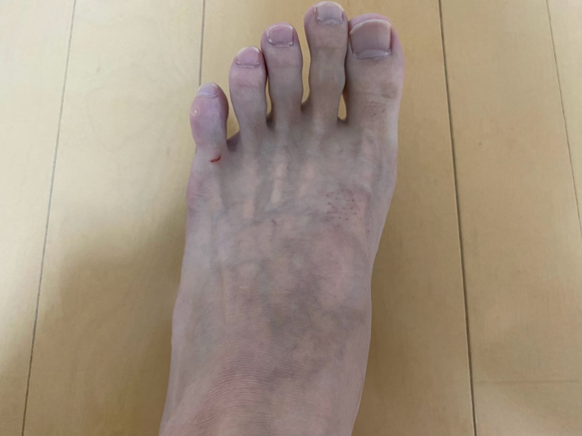 全身脱毛3回目の効果