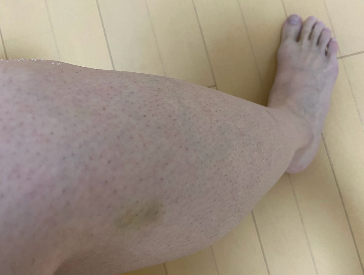 全身脱毛3回目の効果