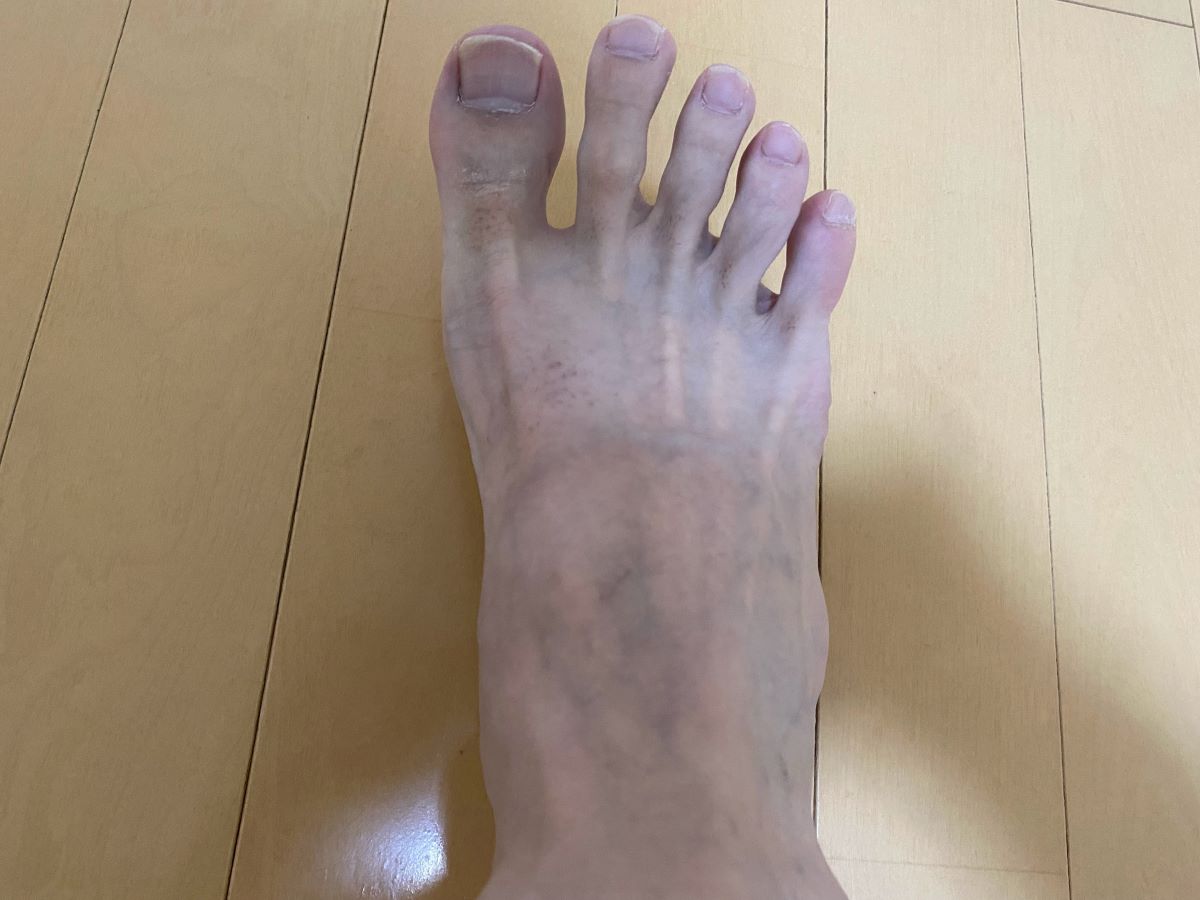 全身脱毛3回目の効果