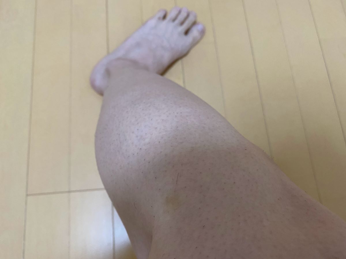 全身脱毛3回目の効果