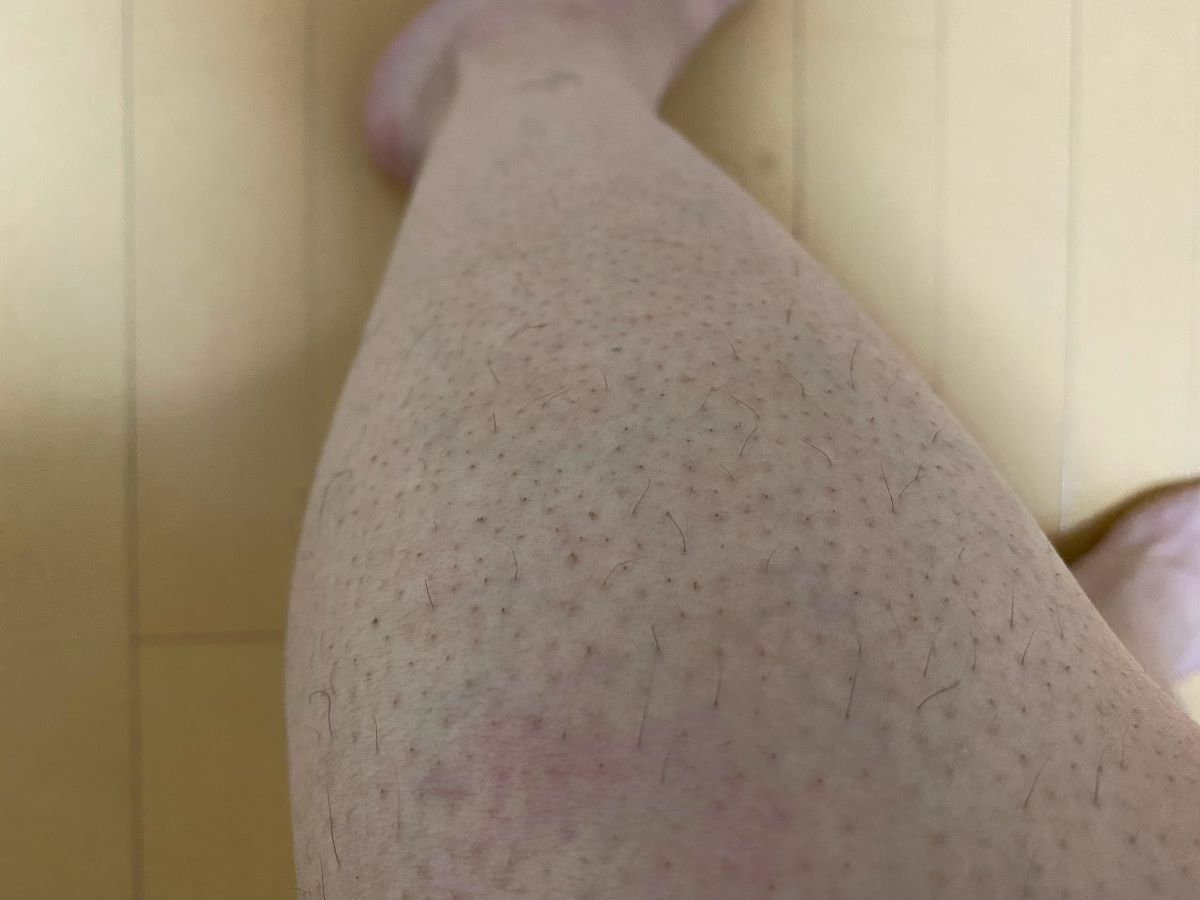 全身脱毛3回目の効果