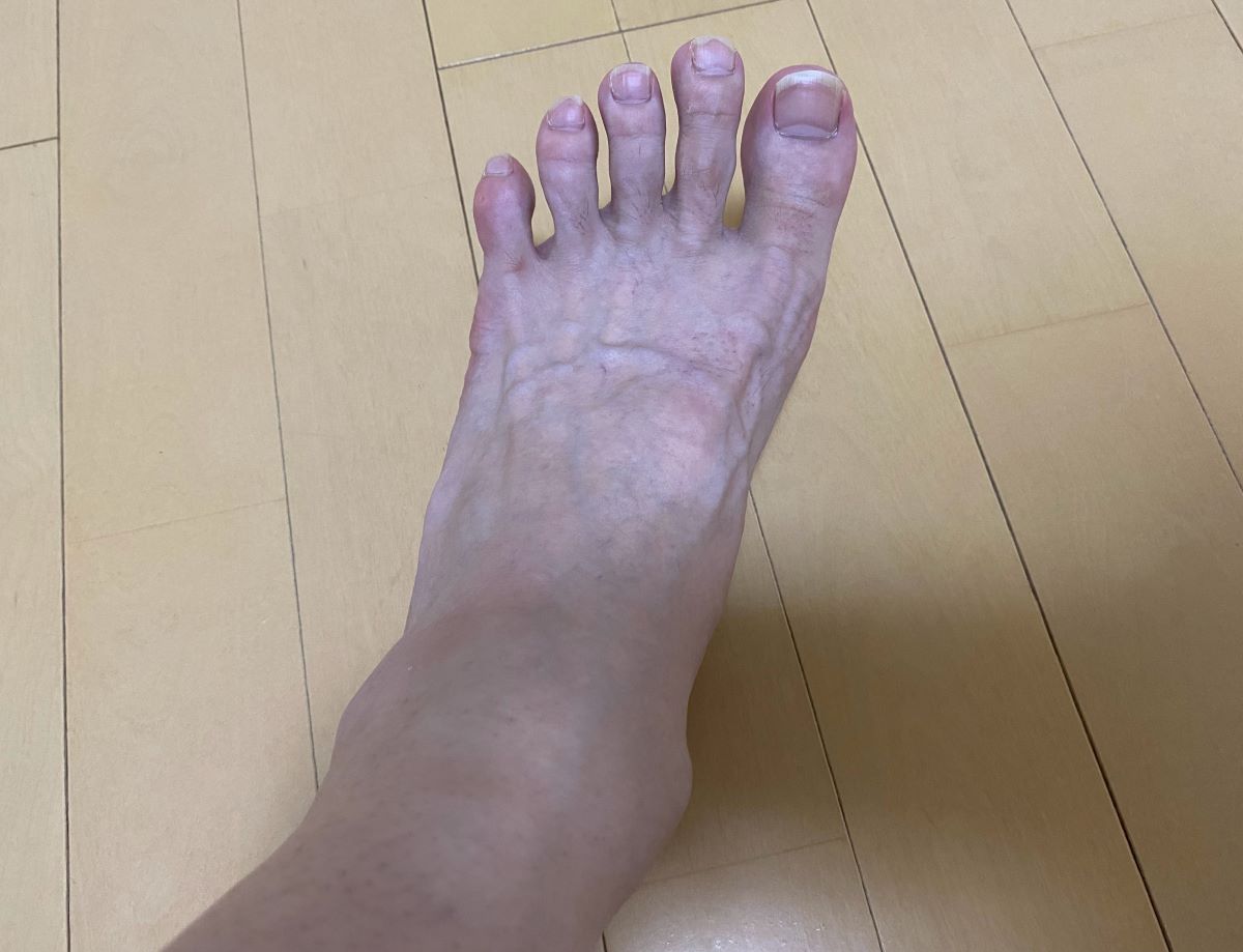 全身脱毛3回目の効果