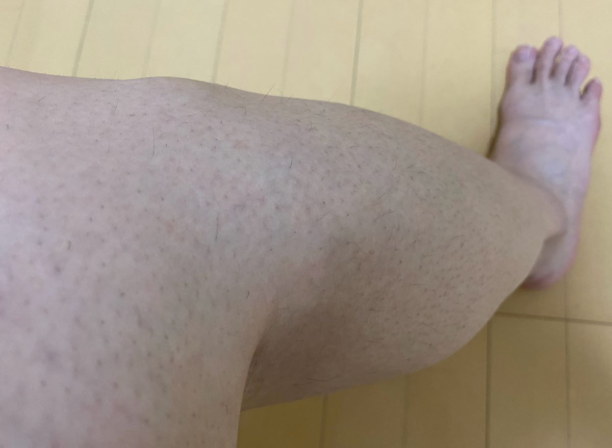 全身脱毛3回目の効果
