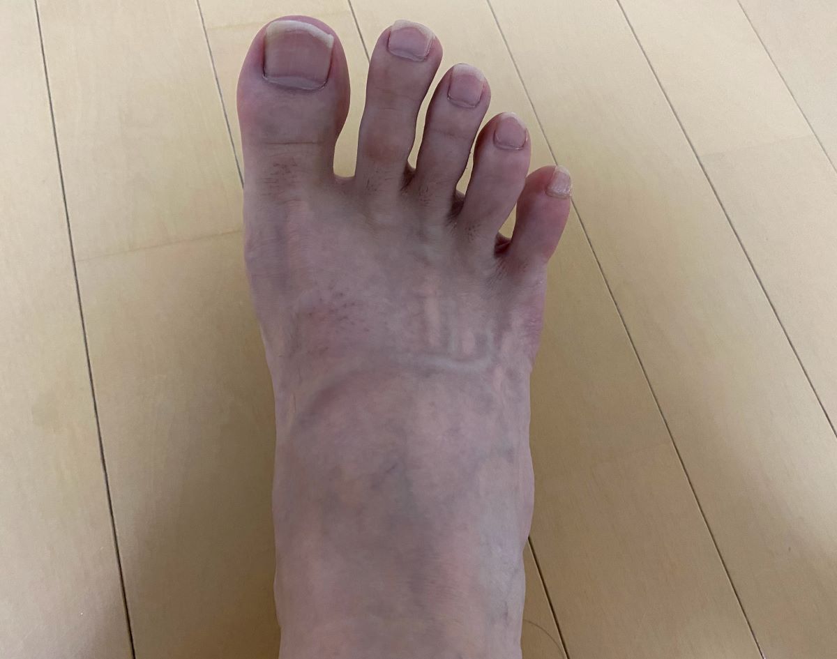 全身脱毛3回目の効果