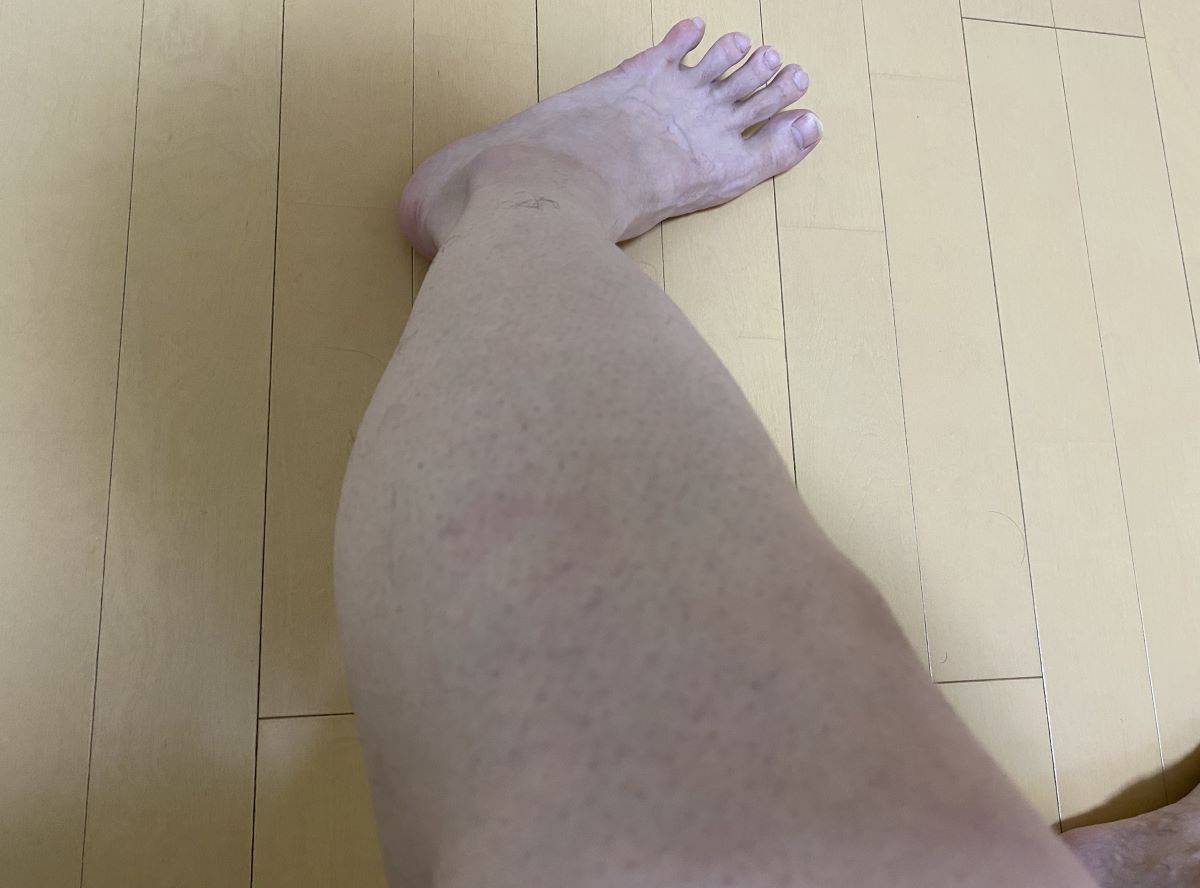 全身脱毛3回目の効果