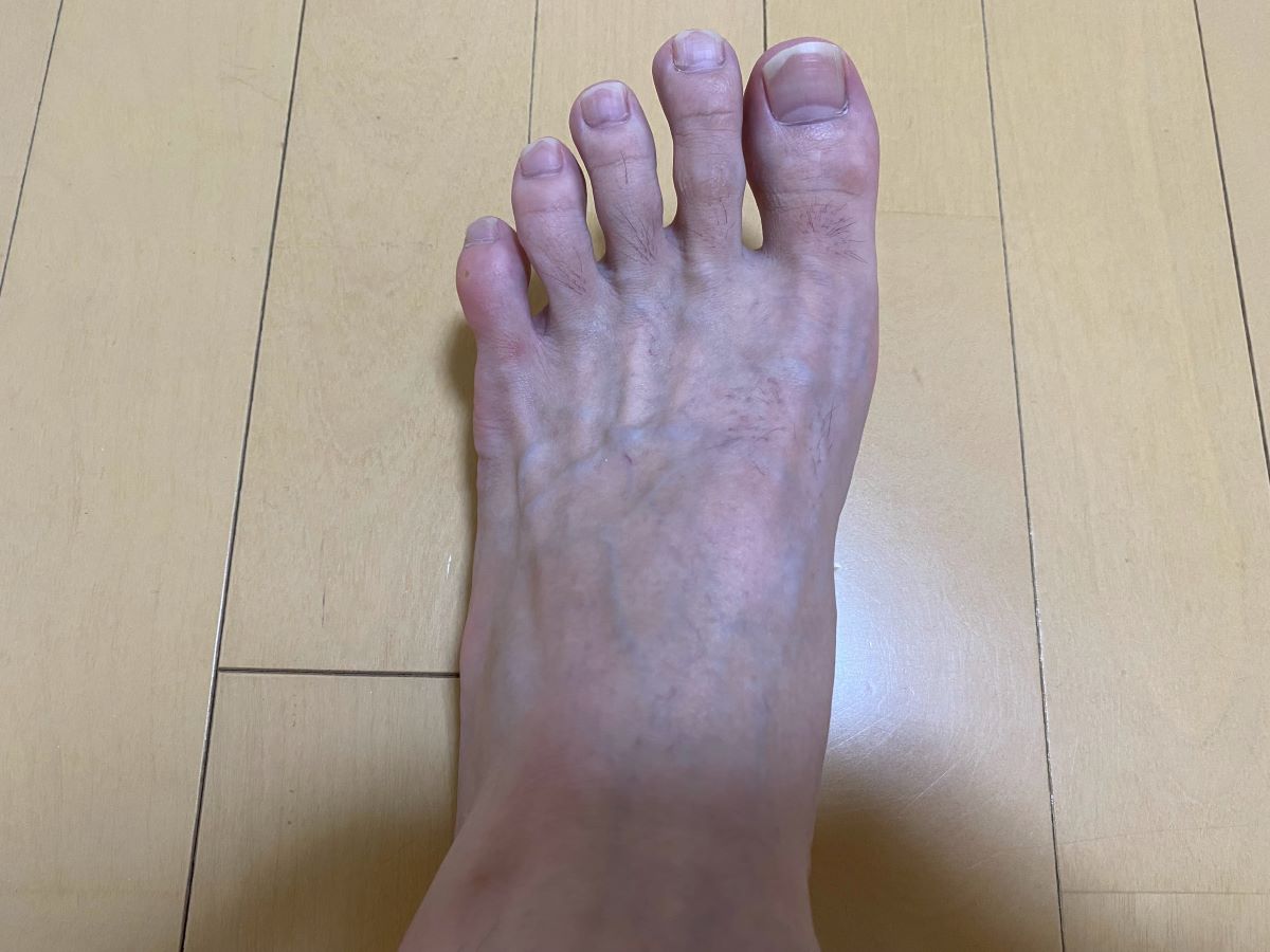 全身脱毛3回目の効果
