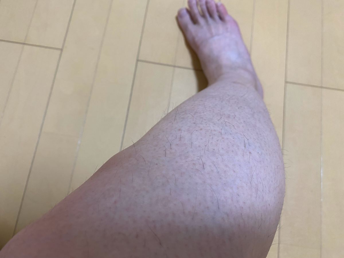 全身脱毛3回目の効果