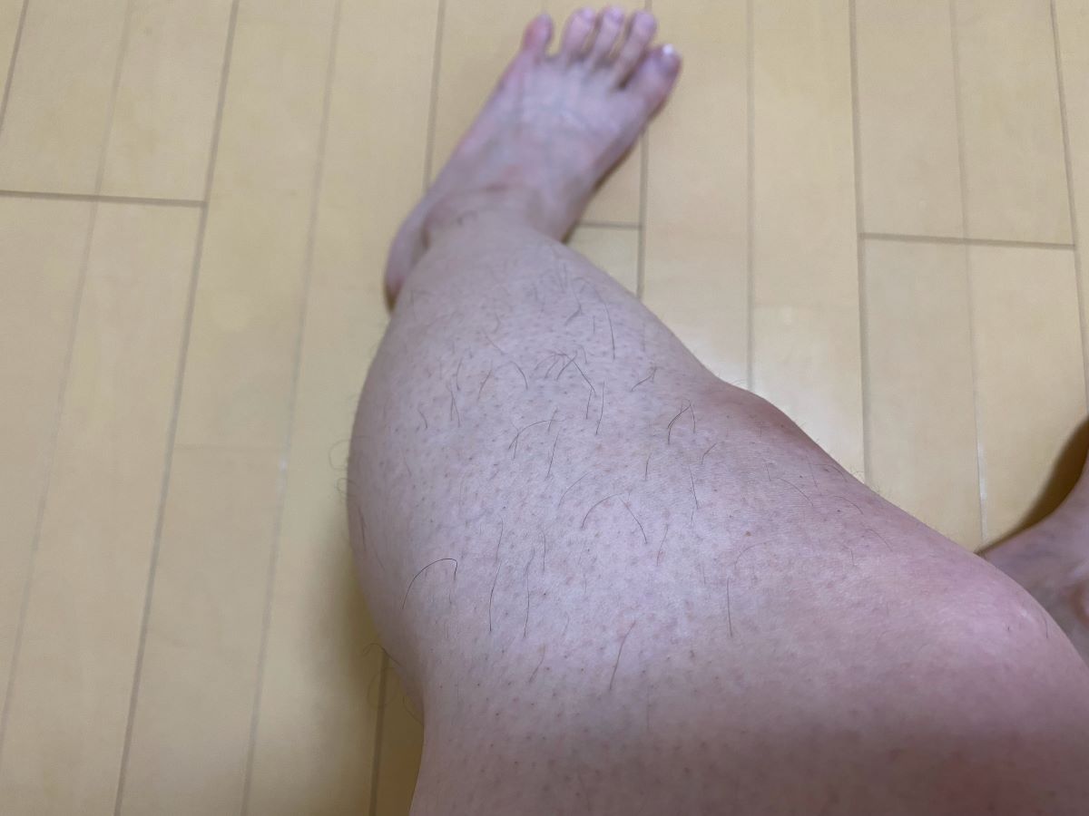 全身脱毛3回目の効果