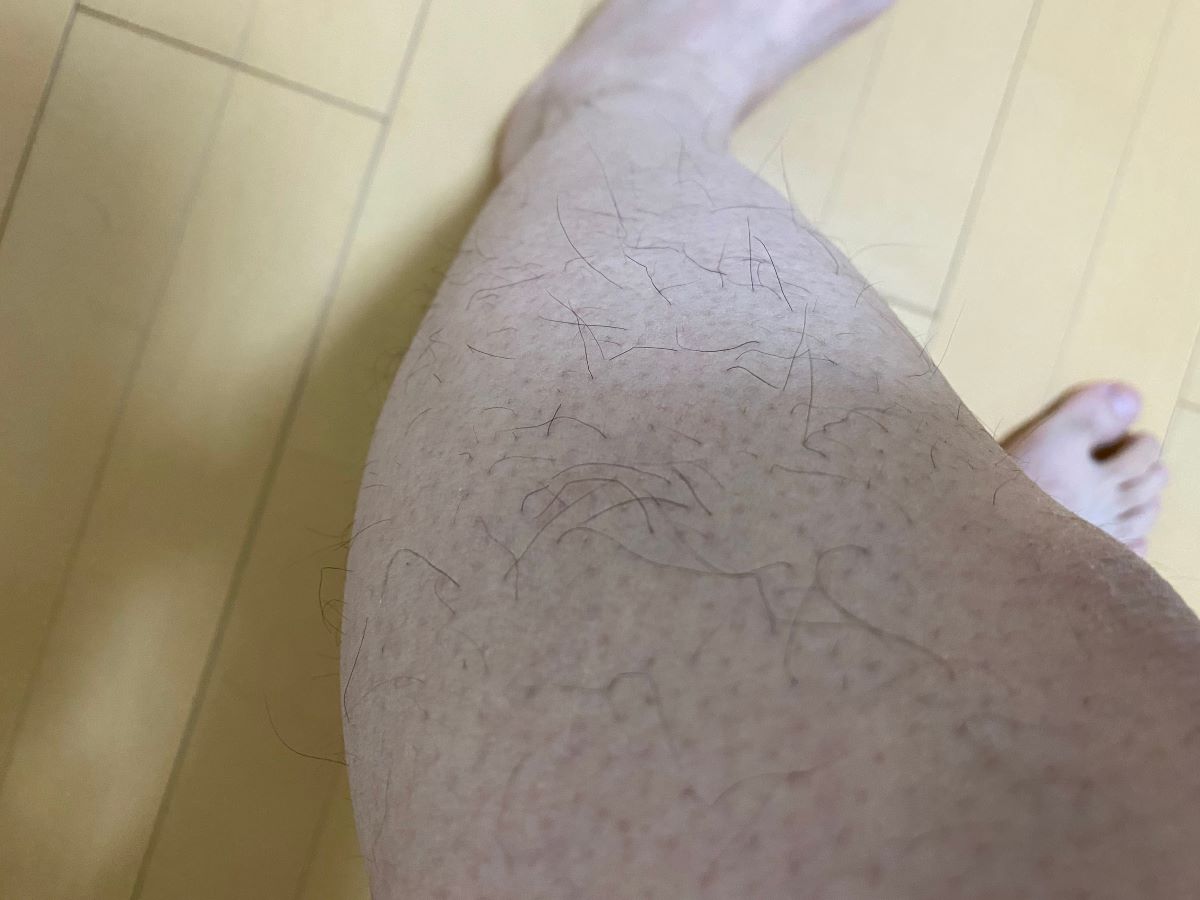 全身脱毛3回目の効果