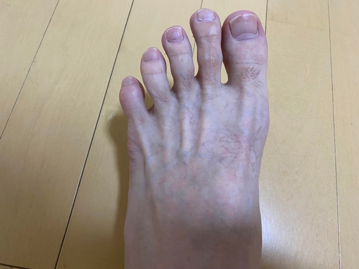 全身脱毛3回目の効果