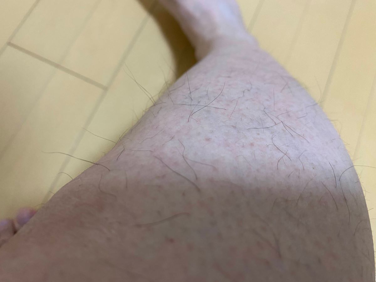 全身脱毛3回目の効果