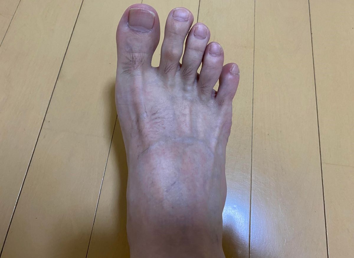 全身脱毛3回目の効果
