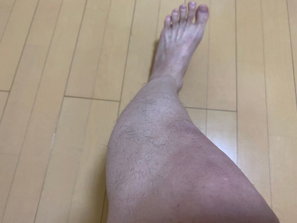 全身脱毛3回目の効果