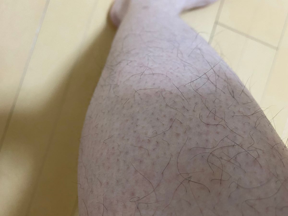 全身脱毛3回目の効果