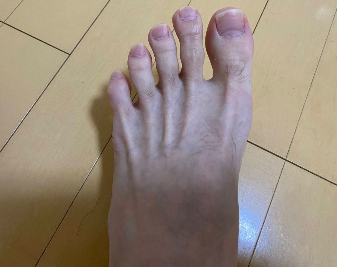 全身脱毛3回目の効果
