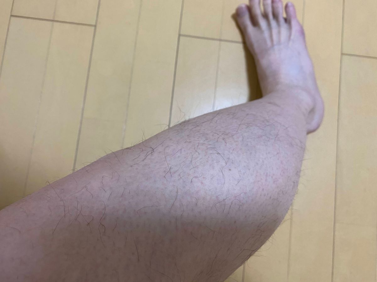 全身脱毛3回目の効果
