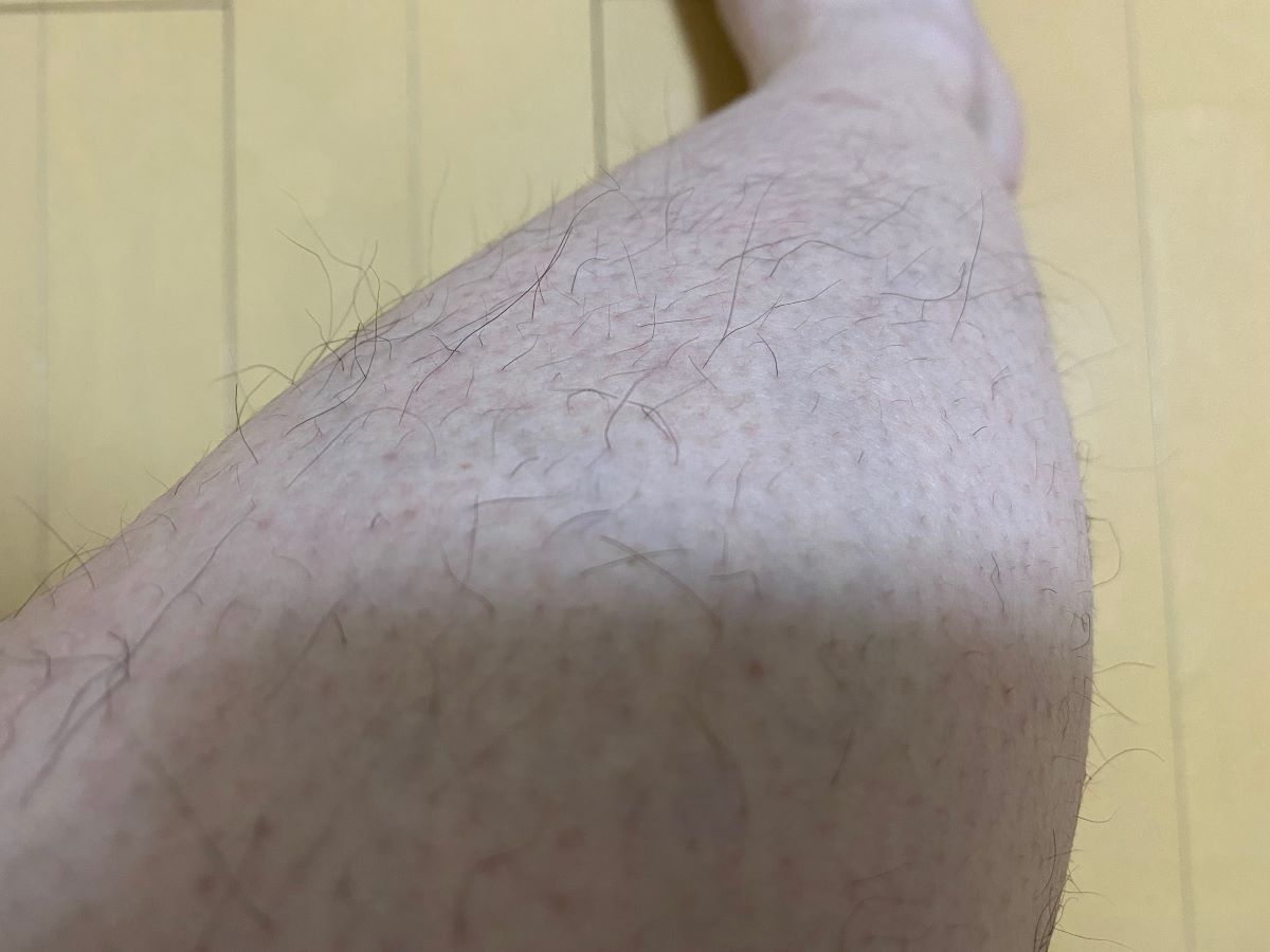 全身脱毛3回目の効果