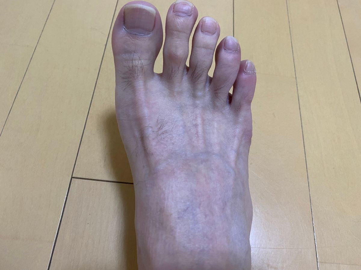 全身脱毛3回目の効果