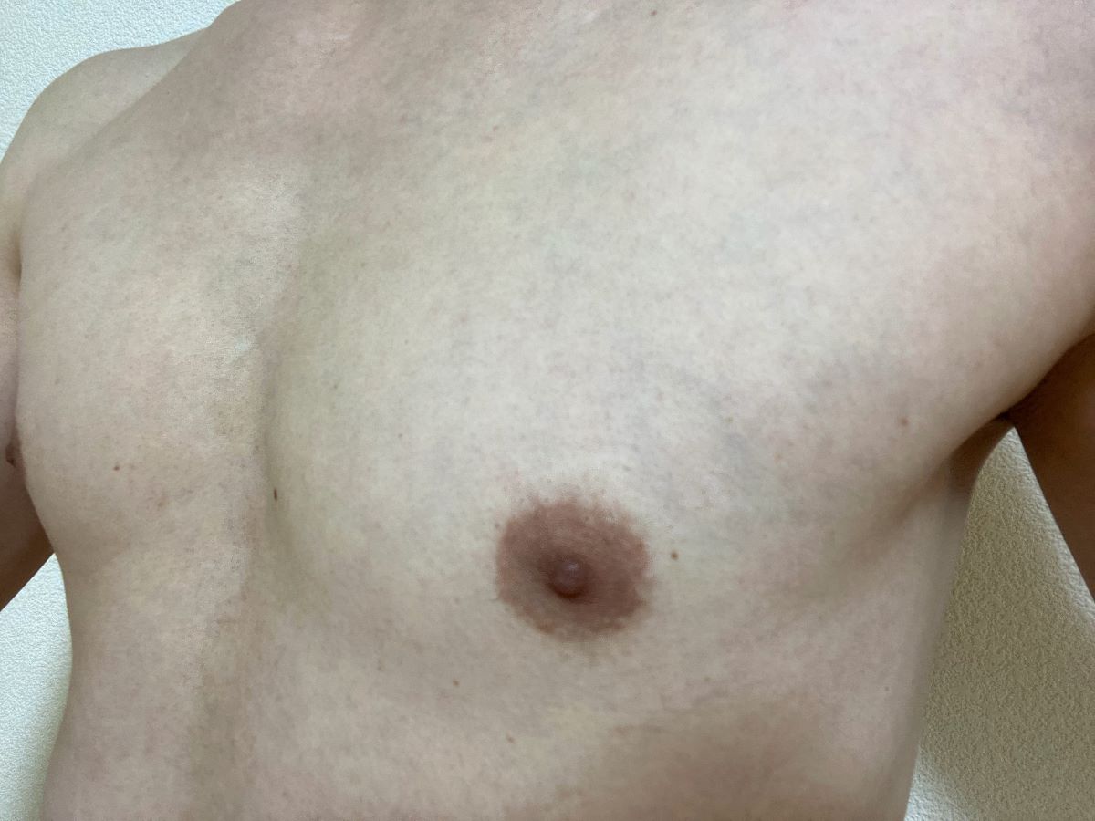 全身脱毛3回目の効果