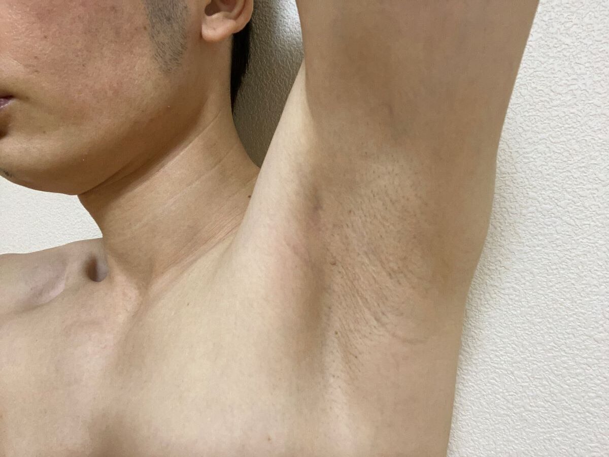 全身脱毛3回目の効果