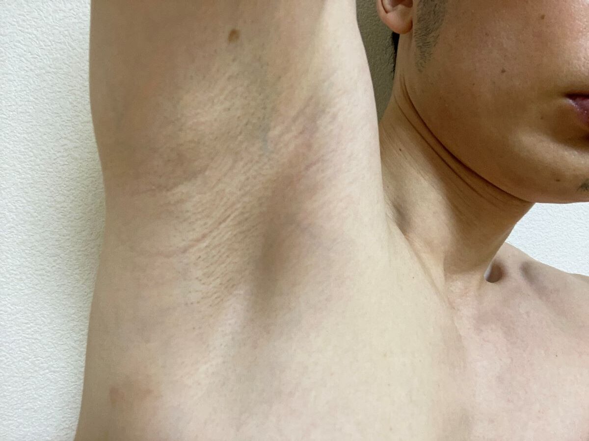 全身脱毛3回目の効果