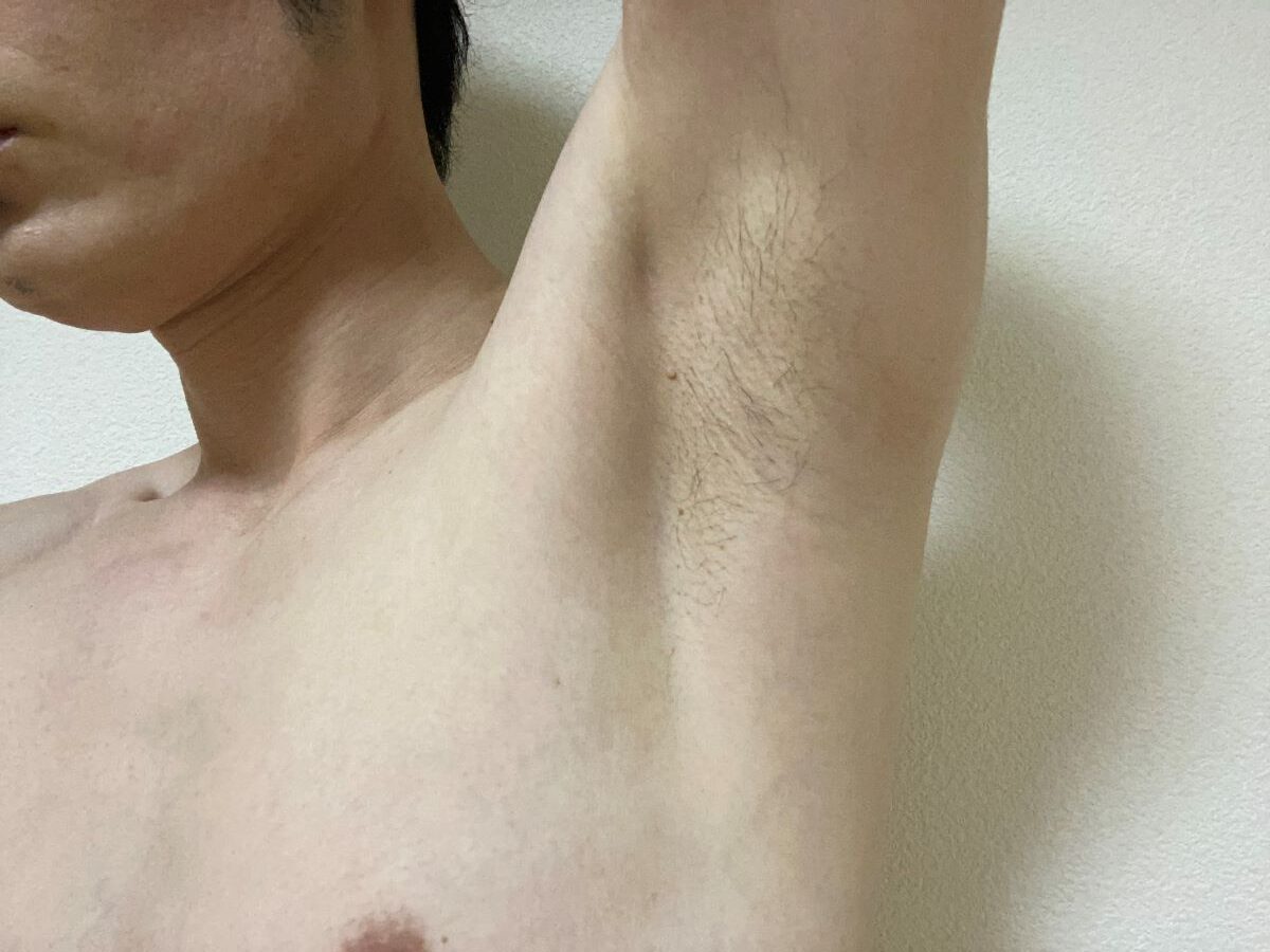 全身脱毛3回目の効果