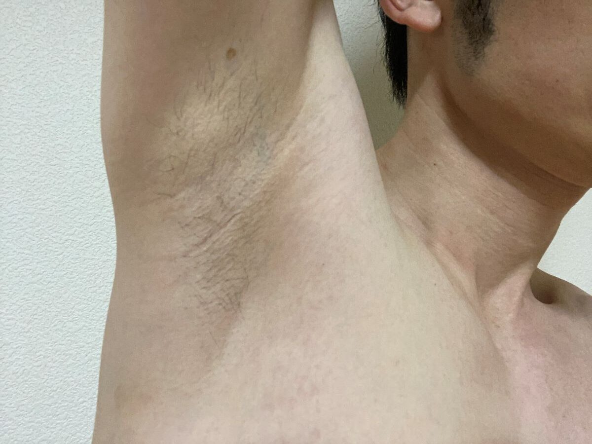 全身脱毛3回目の効果