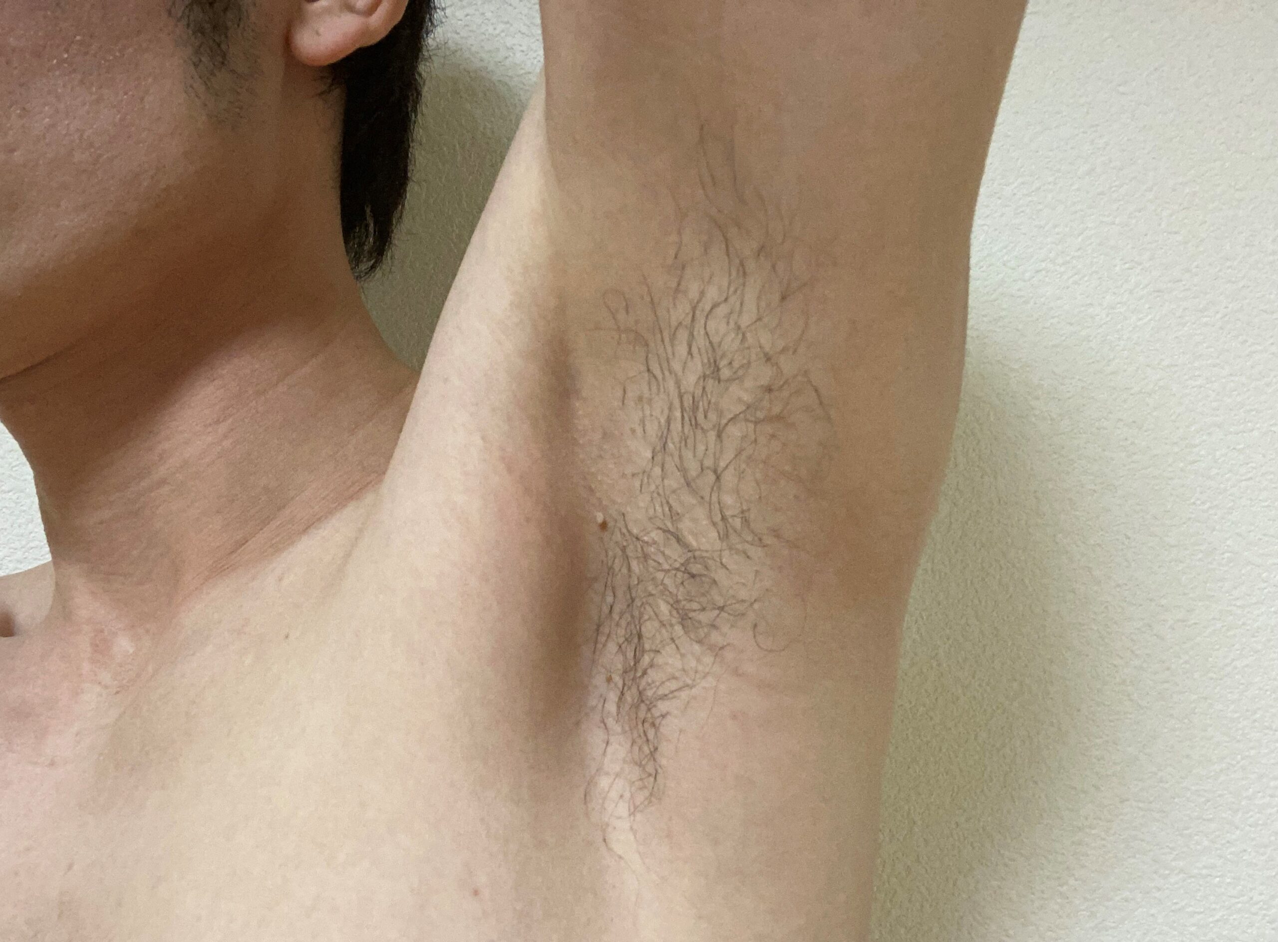 全身脱毛3回目の効果