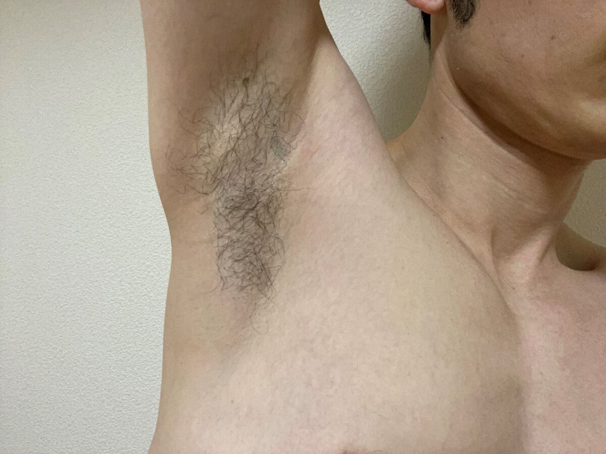 全身脱毛3回目の効果
