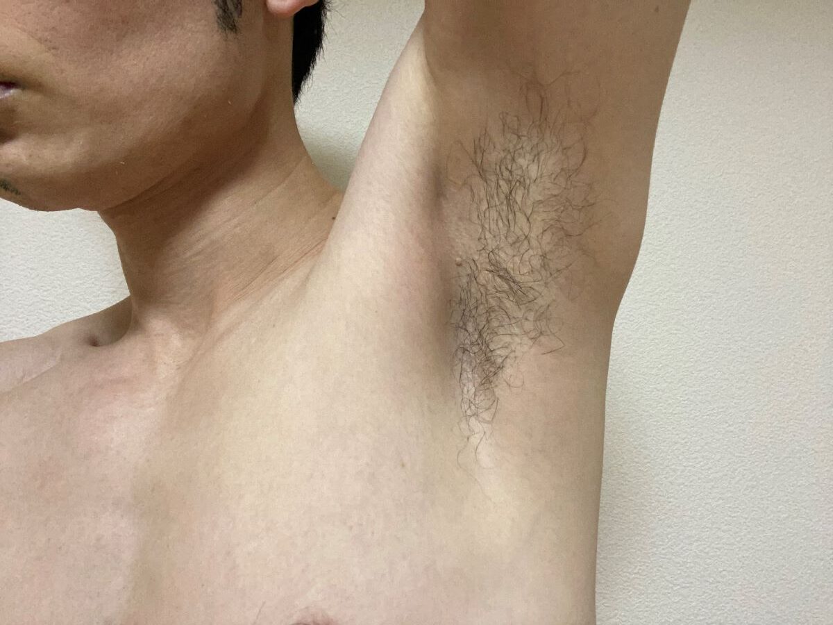 全身脱毛3回目の効果