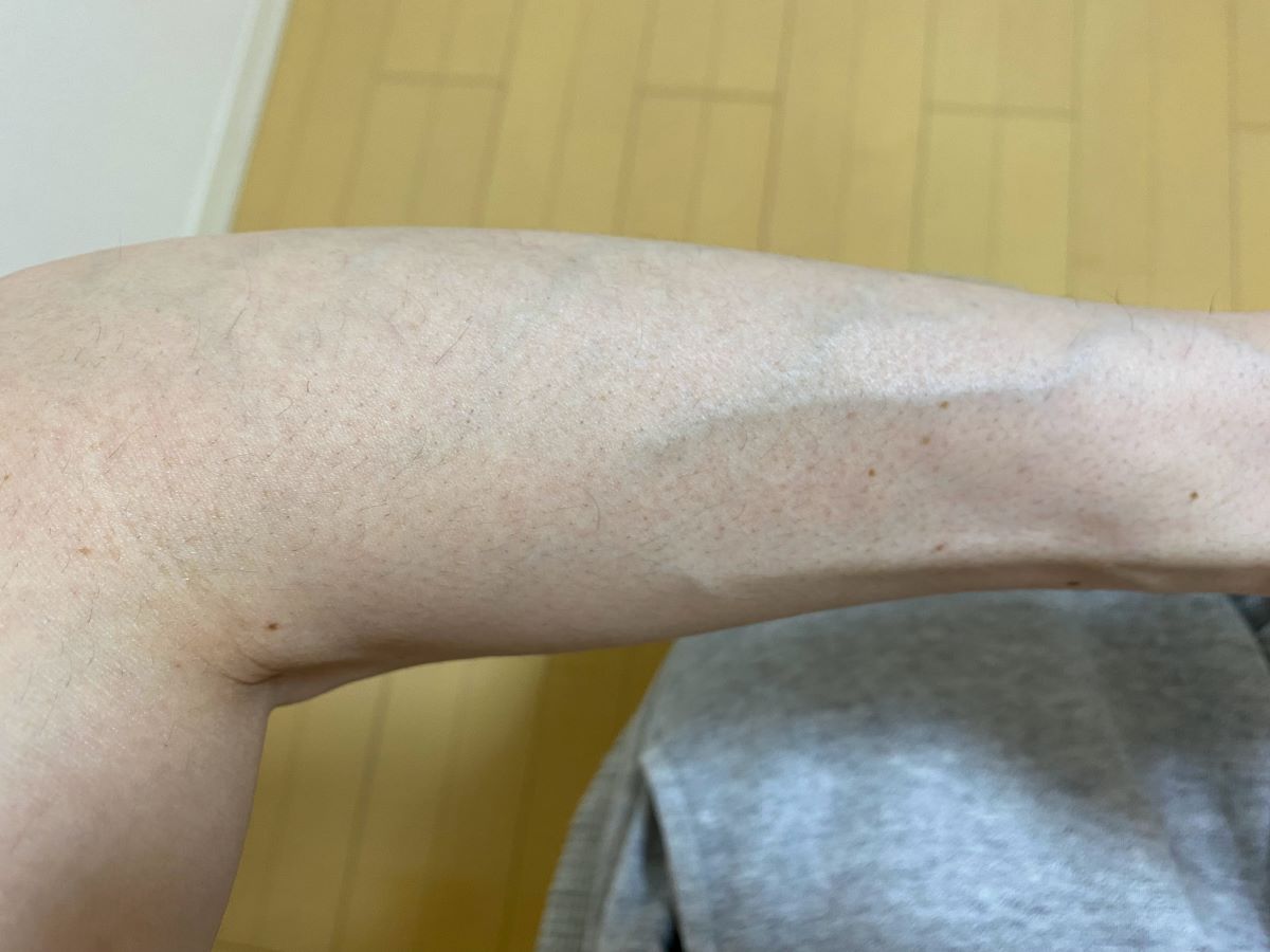 全身脱毛3回目の効果