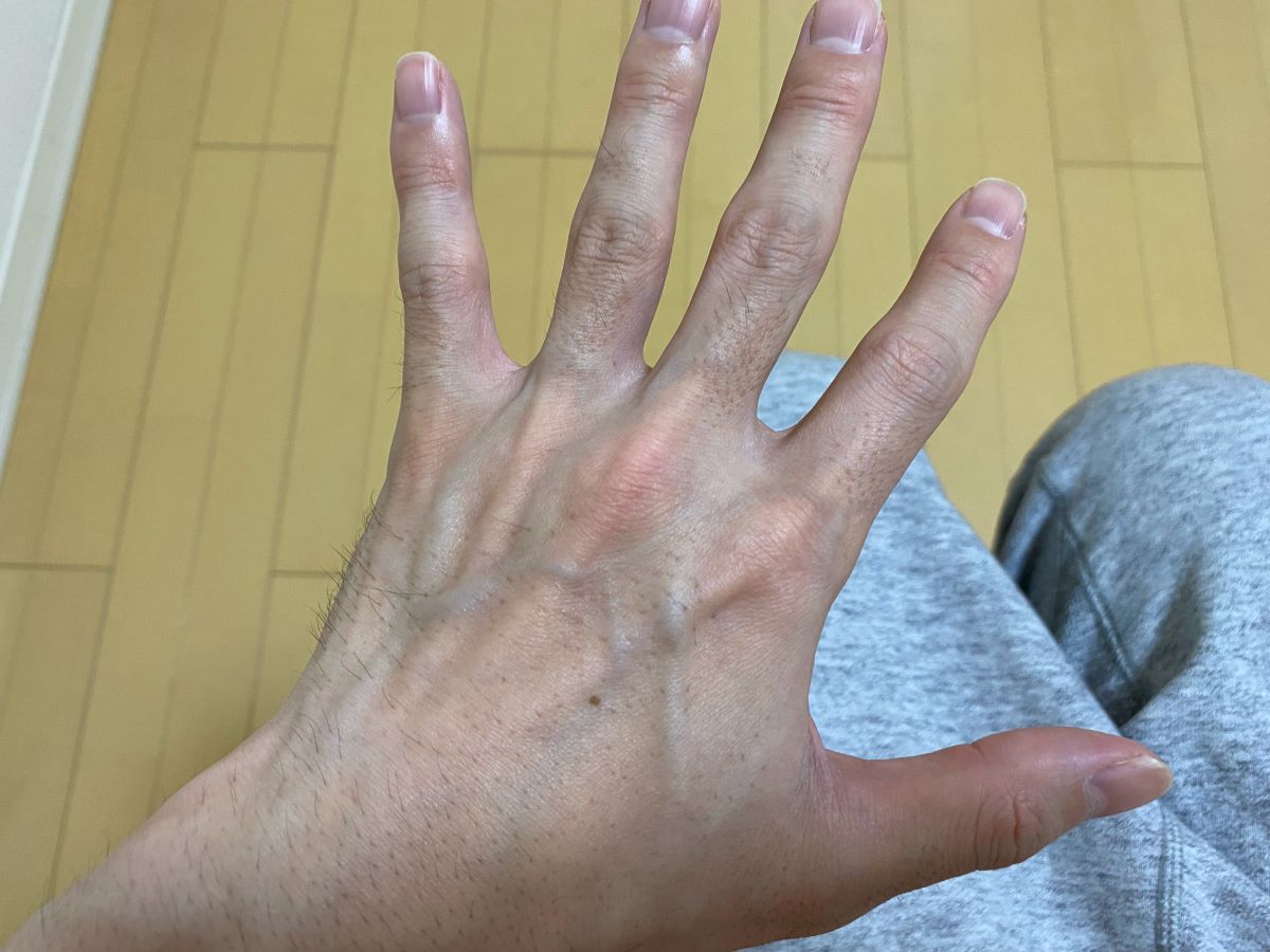 全身脱毛3回目の効果