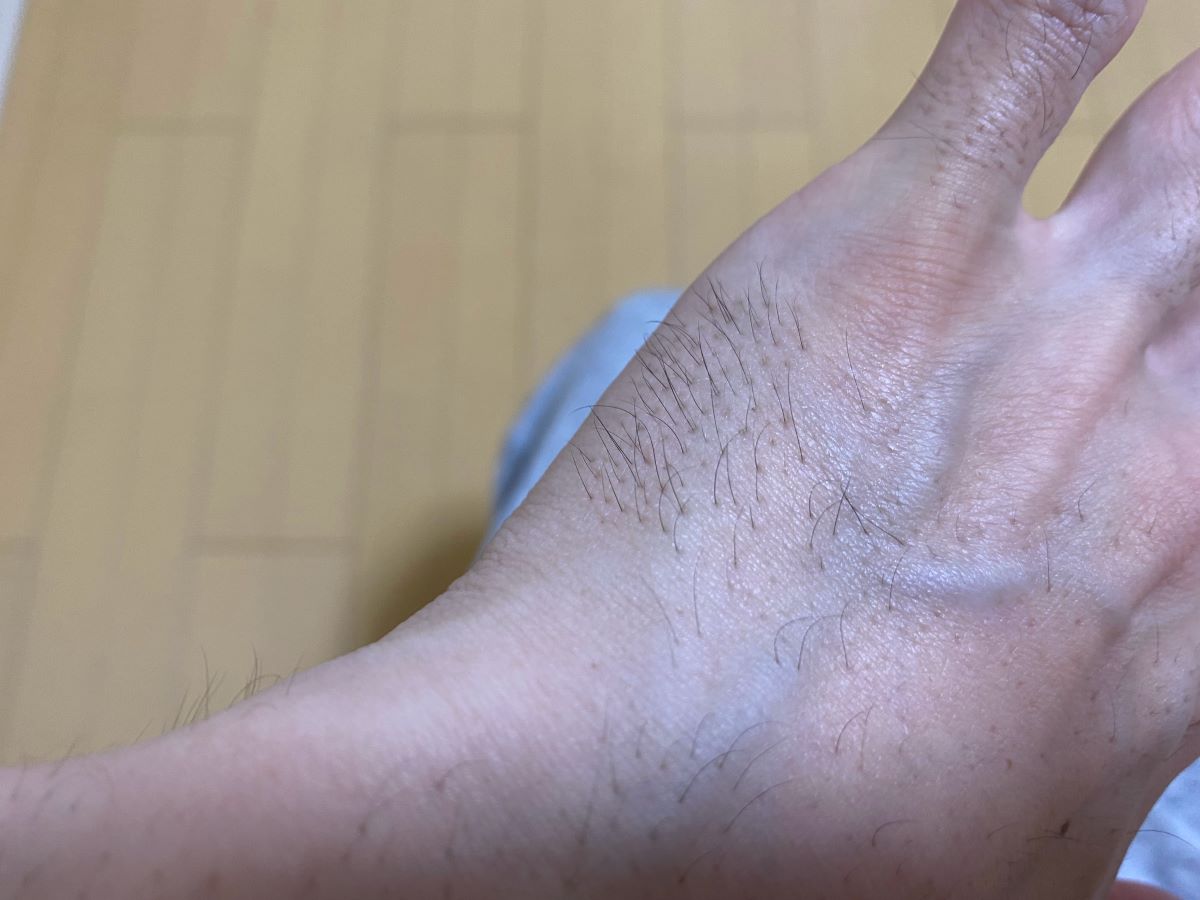全身脱毛3回目の効果