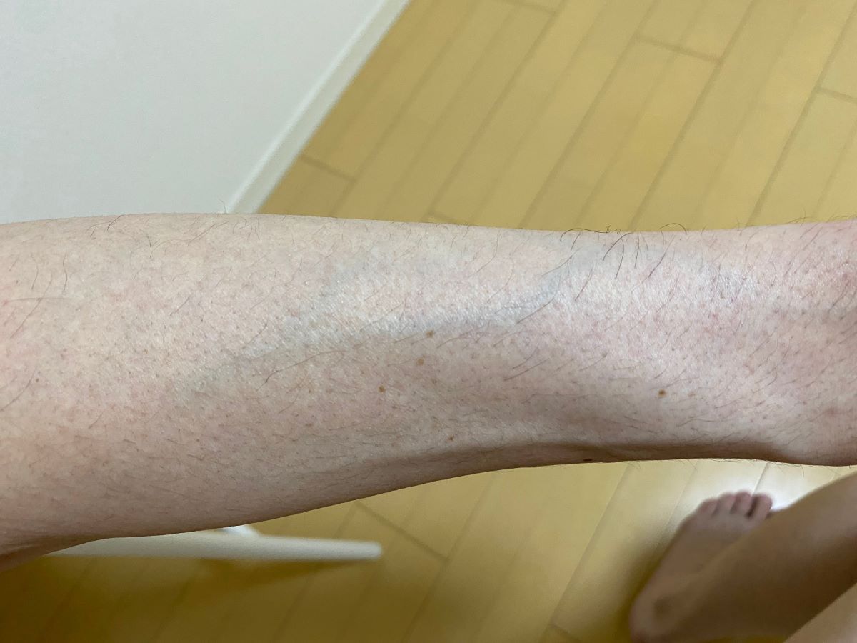 全身脱毛3回目の効果