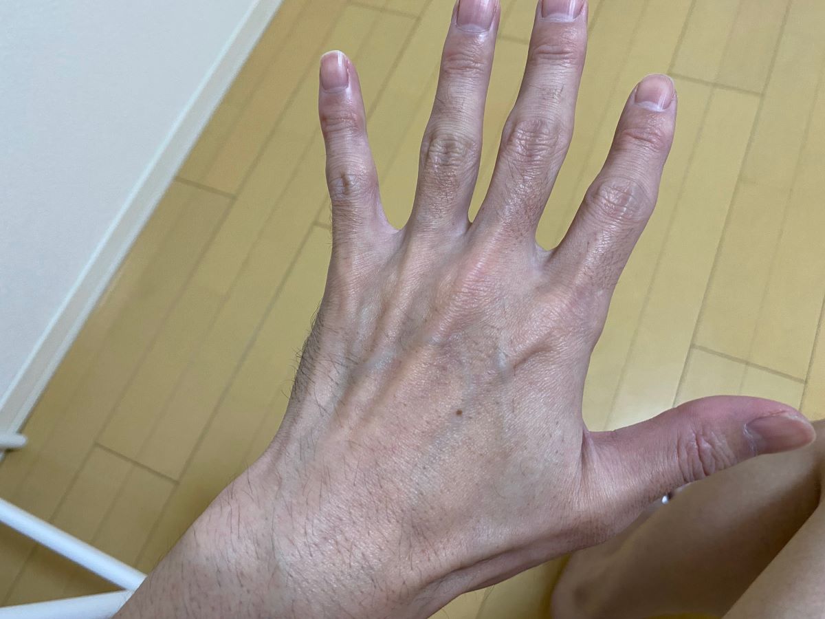 全身脱毛3回目の効果