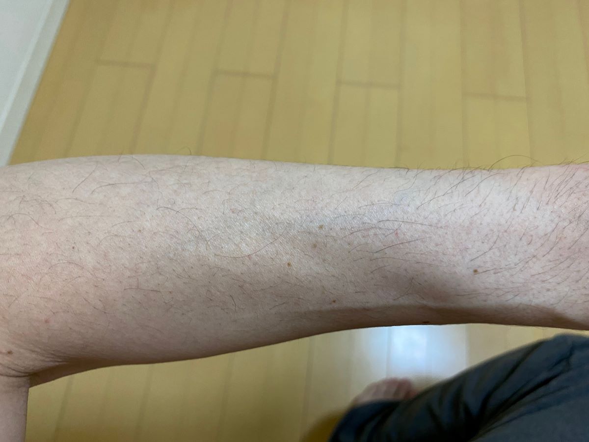全身脱毛3回目の効果