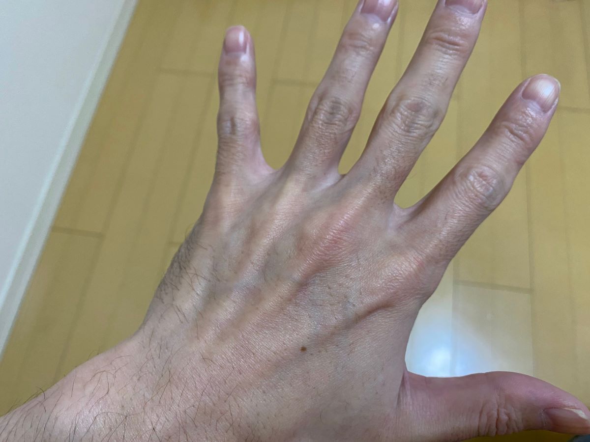 全身脱毛3回目の効果