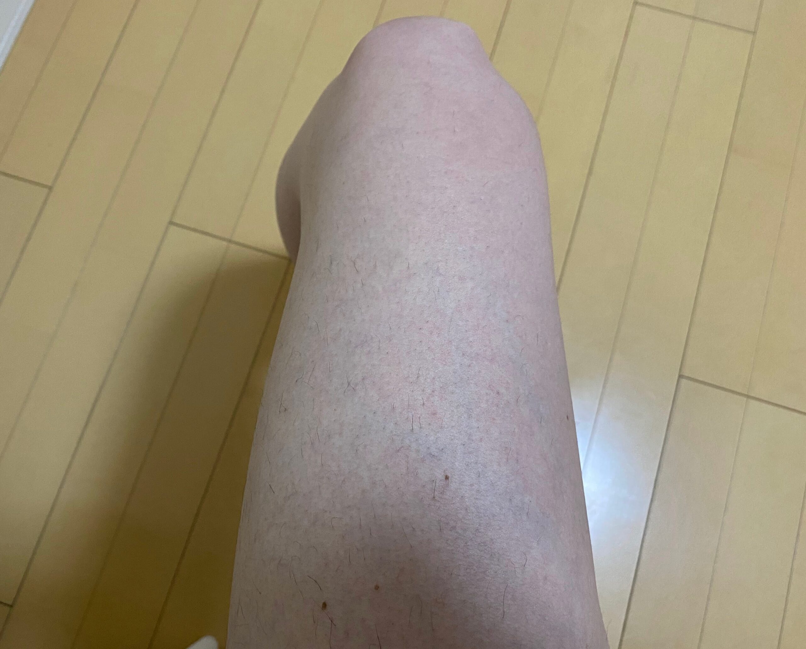 男の全身脱毛効果
