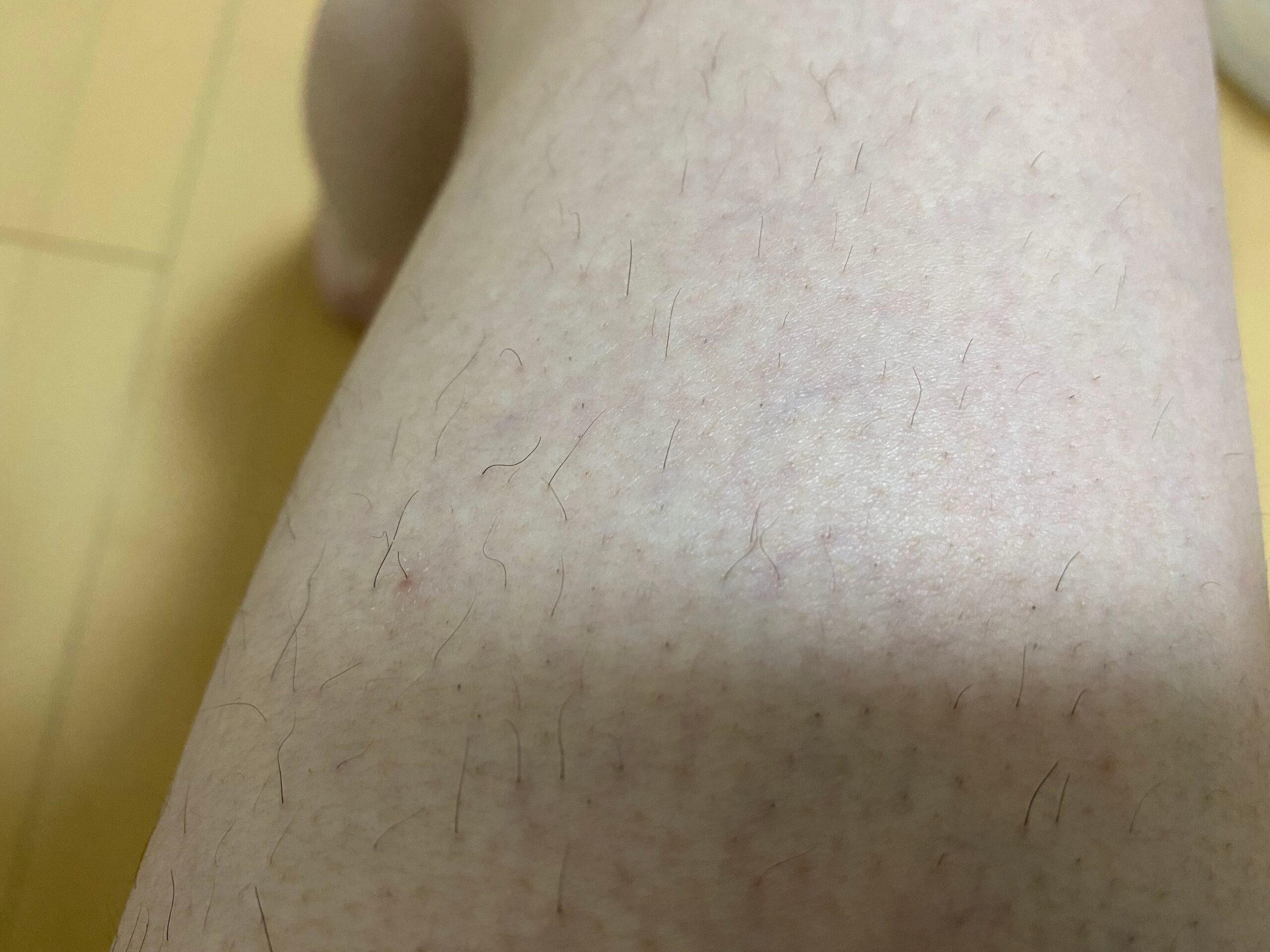 男の全身脱毛効果