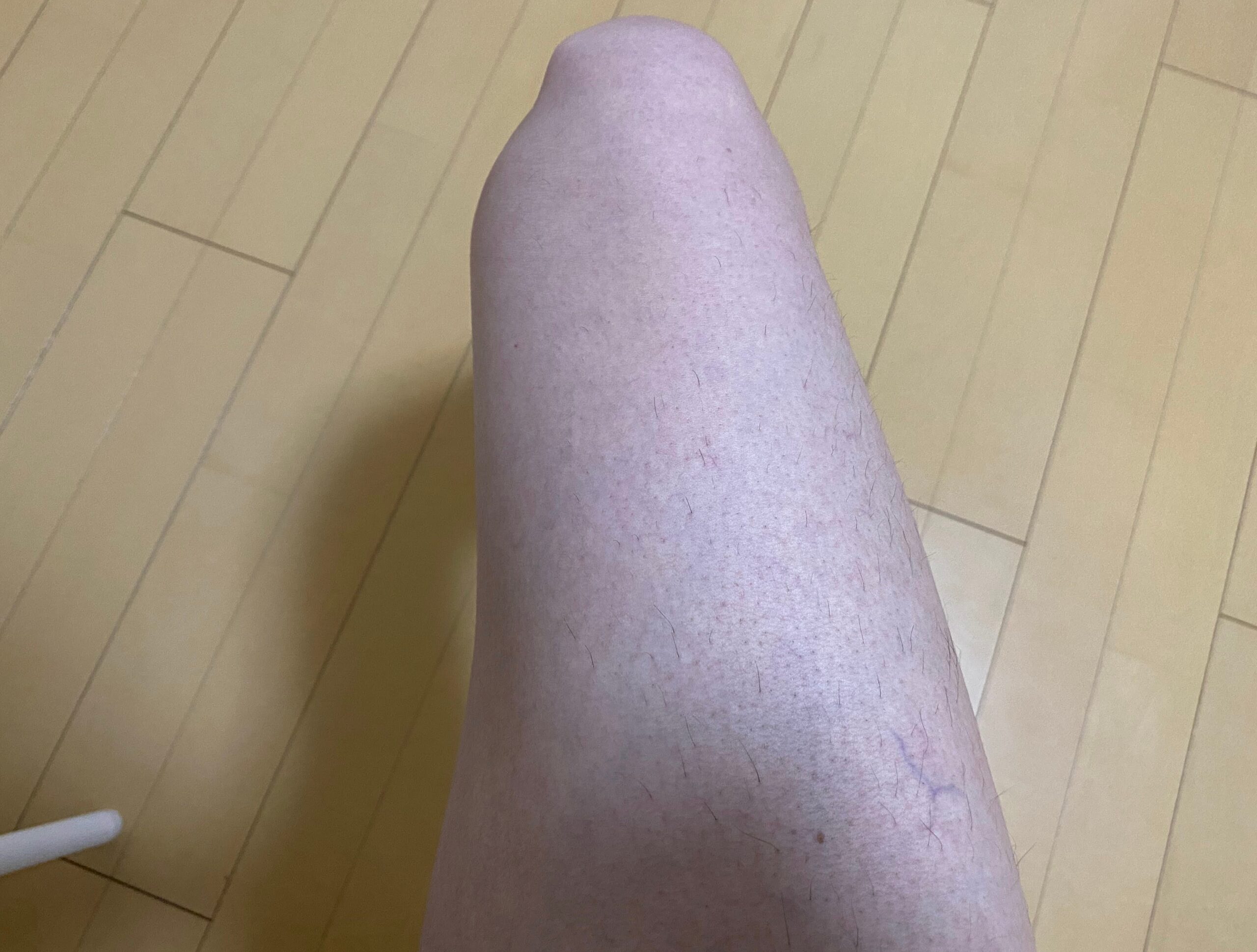 男の全身脱毛効果