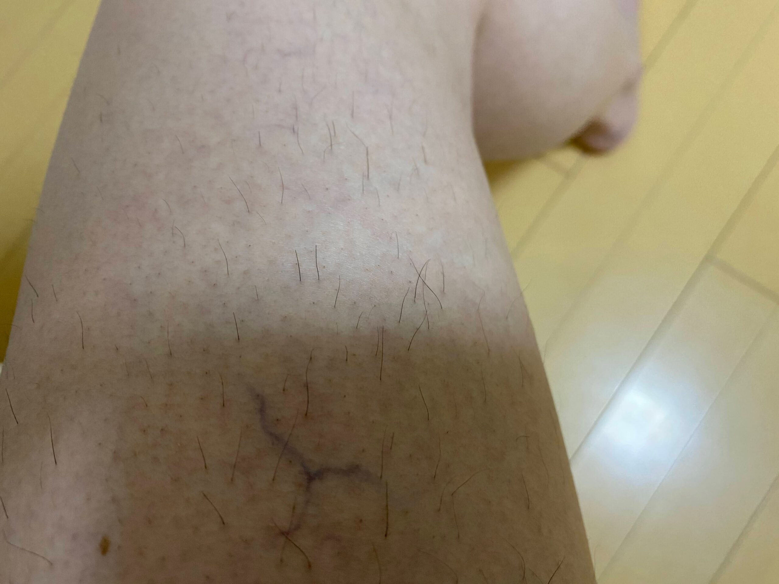 男の全身脱毛効果