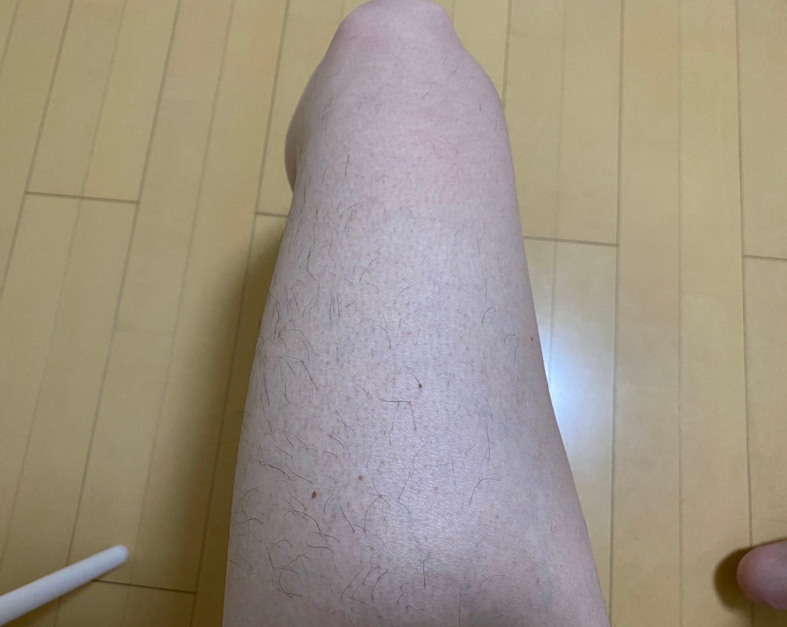男の全身脱毛効果