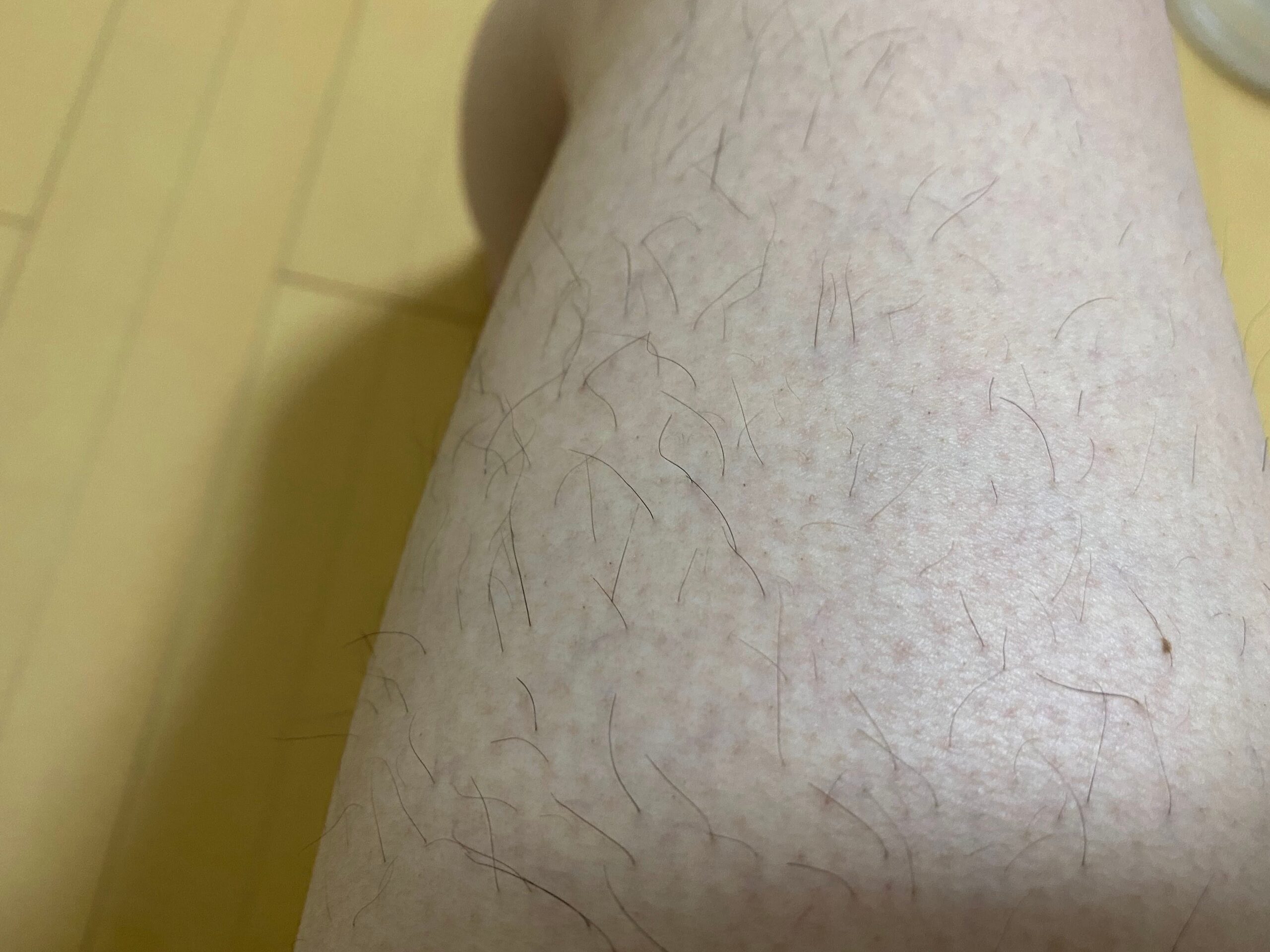 男の全身脱毛効果