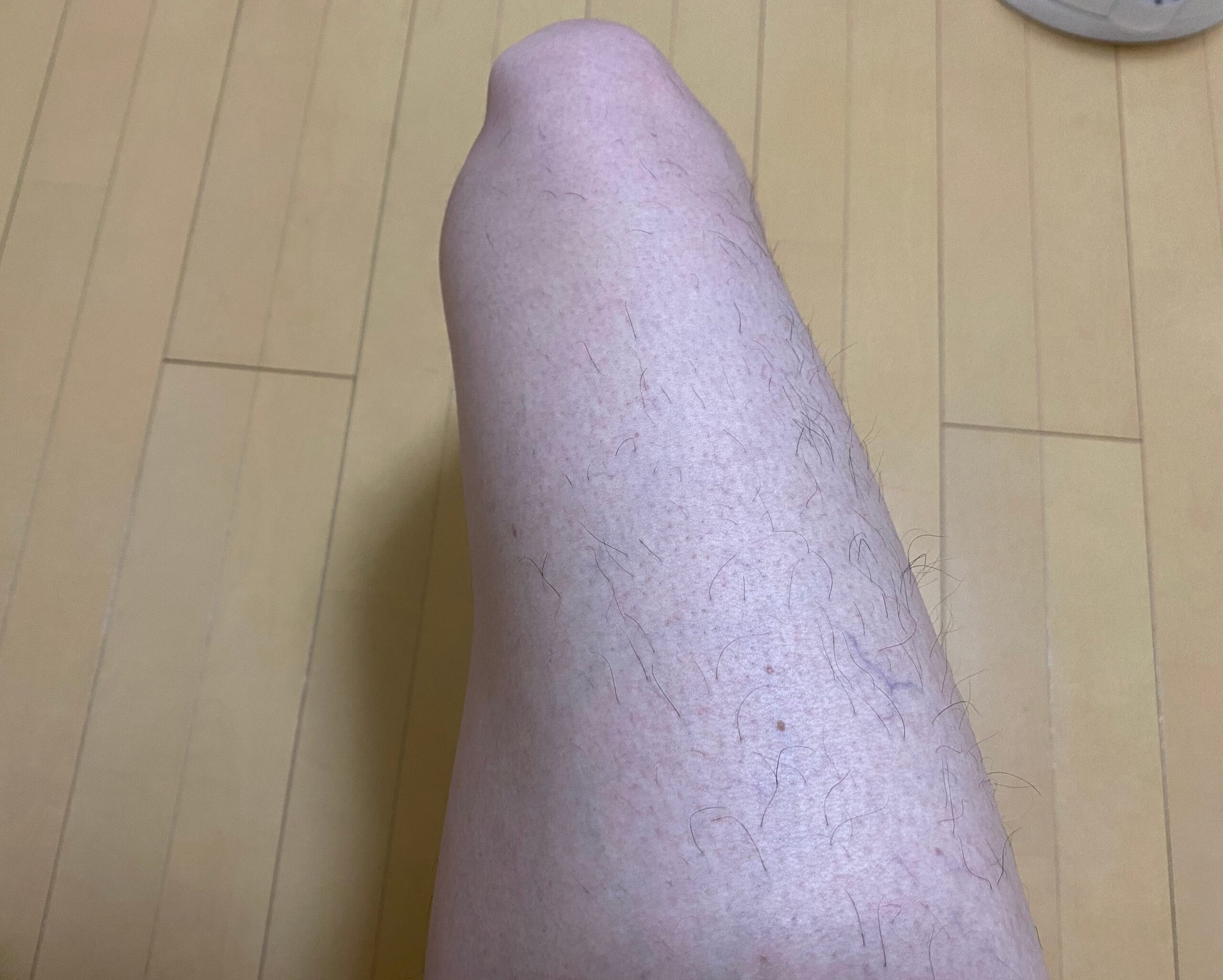 男の全身脱毛効果